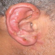 Illustration for article titled Cara Menyembuhkan Penyakit Herpes Simplex